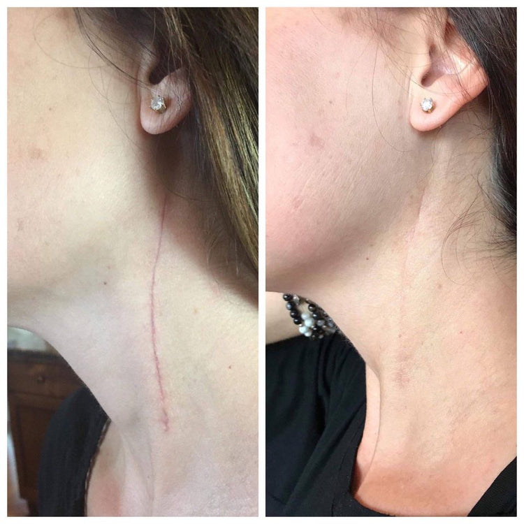 Scar Fade Roller Bottle